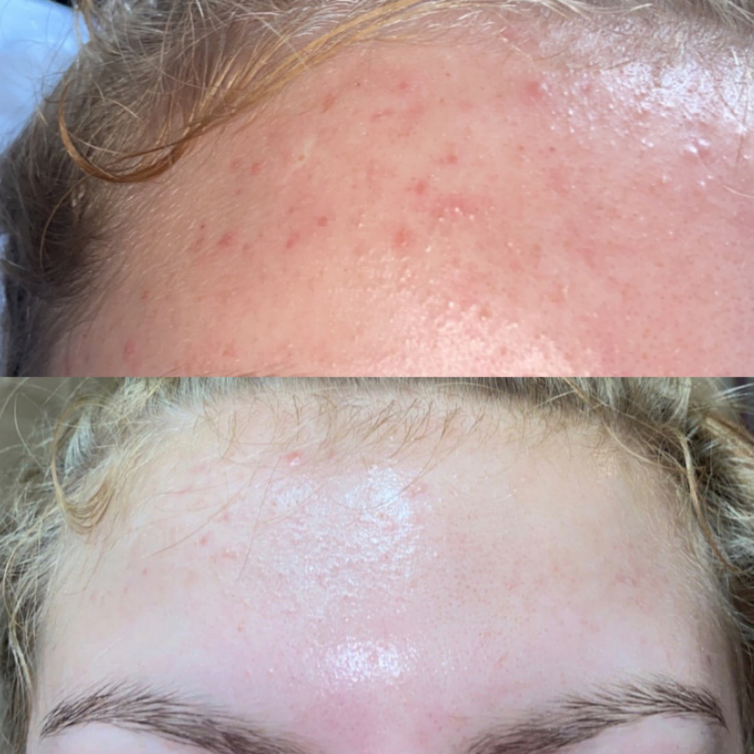 Rosacea
